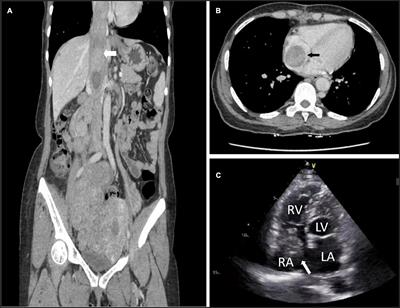 One-stage resection of intravascular leiomyomatosis involving the right heart chamber through a single laparotomy